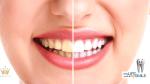 Teeth, Cleaning Tooth, Smoking, Tests,, Tooth Whitening
